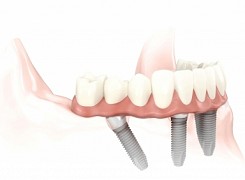 Advantages of Restoring Teeth